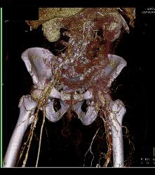 Hardware Extends and Adjacent to Aorta - CTisus CT Scan