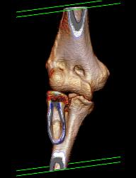 Ulnar Fracture in 3D - CTisus CT Scan