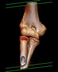 Ulnar Fracture in 3D - CTisus CT Scan