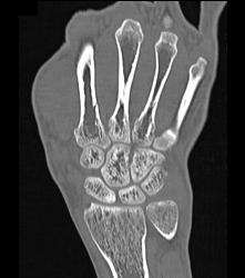 Fracture Base of Second Digit - CTisus CT Scan