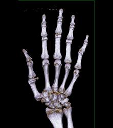 Ulcerations in Distal Digits - CTisus CT Scan