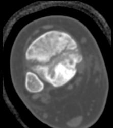 Tibial Fracture - CTisus CT Scan