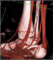 Tibial Fracture - CTisus CT Scan