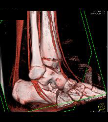 Tibial Fracture - CTisus CT Scan