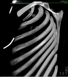 Rib Fracture - CTisus CT Scan