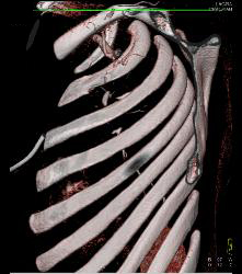 Rib Fracture - CTisus CT Scan