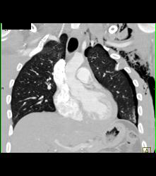 Rib Fracture - CTisus CT Scan