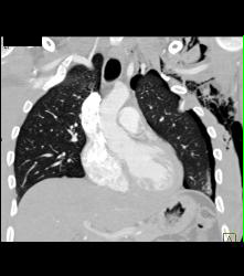 Rib Fracture - CTisus CT Scan