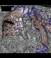 Rib Fracture - CTisus CT Scan