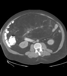 Liposarcoma - CTisus CT Scan