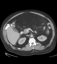 Liposarcoma - CTisus CT Scan