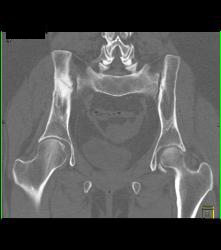 Nonunion Iliac Wing - CTisus CT Scan