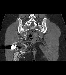 Pelvic Arteriovenous Malformation (AVM) Erodes Bone/ See Full Sequence - CTisus CT Scan