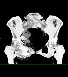 Pelvic Arteriovenous Malformation (AVM) Erodes Bone/ See Full Sequence - CTisus CT Scan