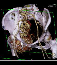 Pelvic Arteriovenous Malformation (AVM) Erodes Bone/ See Full Sequence - CTisus CT Scan