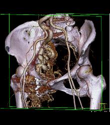 Pelvic Arteriovenous Malformation (AVM) Erodes Bone/ See Full Sequence - CTisus CT Scan