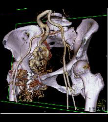 Pelvic Arteriovenous Malformation (AVM) Erodes Bone/ See Full Sequence - CTisus CT Scan