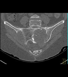 Metastatic Renal Cell Carcinoma - CTisus CT Scan