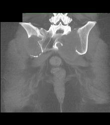 Metastatic Renal Cell Carcinoma - CTisus CT Scan