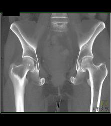 Metastatic Renal Cell Carcinoma - CTisus CT Scan