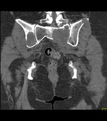 Metastatic Renal Cell Carcinoma - CTisus CT Scan