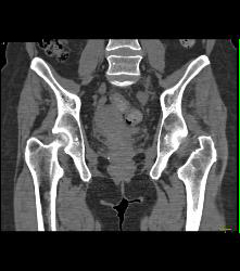 Metastatic Renal Cell Carcinoma - CTisus CT Scan