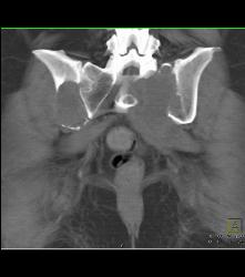 Metastatic Renal Cell Carcinoma - CTisus CT Scan