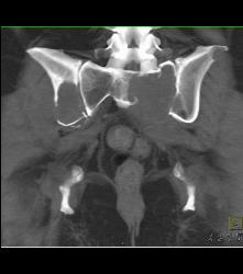 Metastatic Renal Cell Carcinoma - CTisus CT Scan