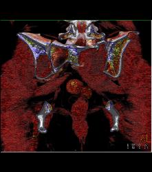 Metastatic Renal Cell Carcinoma - CTisus CT Scan