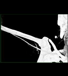 Patent Axillary and Branchial Artery S/p Trauma - CTisus CT Scan