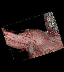 Patent Axillary and Branchial Artery S/p Trauma - CTisus CT Scan