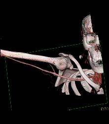 Patent Axillary and Branchial Artery S/p Trauma - CTisus CT Scan