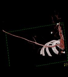 Patent Axillary and Branchial Artery S/p Trauma - CTisus CT Scan