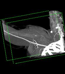 Patent Axillary and Branchial Artery S/p Trauma - CTisus CT Scan