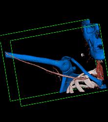 Patent Axillary and Branchial Artery S/p Trauma - CTisus CT Scan