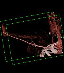 Patent Axillary and Branchial Artery S/p Trauma - CTisus CT Scan