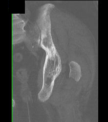 Paget Disease and Femur Fracture - CTisus CT Scan