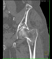 Paget Disease and Femur Fracture - CTisus CT Scan