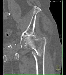 Paget Disease and Femur Fracture - Musculoskeletal Case Studies ...