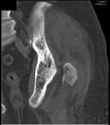 Paget Disease and Femur Fracture - CTisus CT Scan