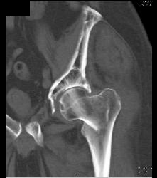 Paget Disease and Femur Fracture - CTisus CT Scan