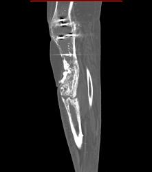 Nonunion - CTisus CT Scan