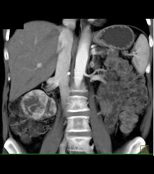 Von Hippel-Lindau syndrome (VHL) With Right Renal Cell Carcinoma Pancreatic Cystadenomas and Bone Metastases - CTisus CT Scan