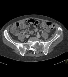 Von Hippel-Lindau syndrome (VHL) With Right Renal Cell Carcinoma Pancreatic Cystadenomas and Bone Metastases - CTisus CT Scan