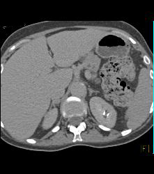 Von Hippel-Lindau syndrome (VHL) With Right Renal Cell Carcinoma Pancreatic Cystadenomas and Bone Metastases - CTisus CT Scan