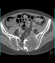 Von Hippel-Lindau syndrome (VHL) With Right Renal Cell Carcinoma Pancreatic Cystadenomas and Bone Metastases - CTisus CT Scan