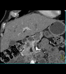 Von Hippel-Lindau syndrome (VHL) With Right Renal Cell Carcinoma Pancreatic Cystadenomas and Bone Metastases - CTisus CT Scan