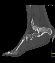 Degenerative Joint Disease (DJD) Foot With Neurofibroma - CTisus CT Scan