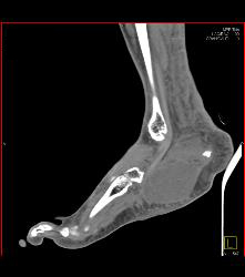 Degenerative Joint Disease (DJD) Foot With Neurofibroma - CTisus CT Scan