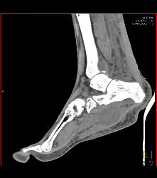 Degenerative Joint Disease (DJD) Foot With Neurofibroma - CTisus CT Scan